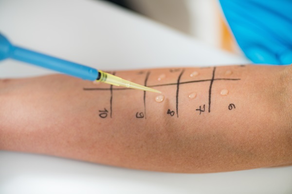 Allergy - Skin Prick Testing